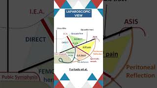 Inguinal Anatomy for Laparoscopic Hernia surgery #surgicaleducation #doctor #hernia
