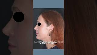 Rhinoplasty - Supratip Nasal Definition | #shorts