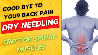 Dry Needling: Is It Worth the Pain?