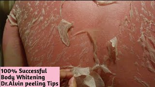 Dr. Alvin নিজের হাতে করা Step By Step | Body Whitening Peeling process | Spot Remove | BD Authorized