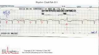 ECG Interpretation Tutorial - ChalkTalk 11 - Basic Level
