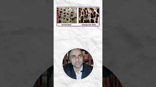 Why spine fractures in osteoporosis? क्यों हो जाता है #osteoporosis में आसानी से फ्रैक्चर? #shorts