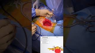 What is Posterior Cervical Decompression Surgery? 🤓