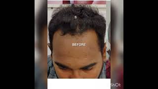 #hairgrowth #hairtransformation #hair #besthairtransplant #haircare #besthairtransplantinindia