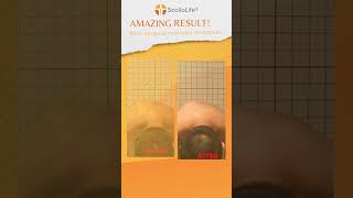 20-year-old NS boy: curve reduced, posture improved—without surgery