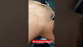 SHOULDER PAIN RELIEF with Dry Needling and ESTIM!
