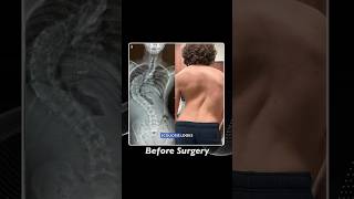 How we fix scoliosis. #BackSurgery #SpineSurgery #BackPain #Spine #medical #doctor #scoliosis