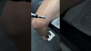 Optimizing Triceps Recovery: Dry Needling with E-Stim for Enhanced Muscle Activation