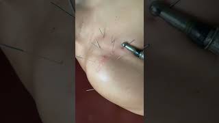 SHOULDER PAIN RELIEF with Electroneedling? #physiotherapy