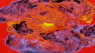 Breast Cancer  visualization by HiP-CT (Hierarchical phase-contrast tomography)