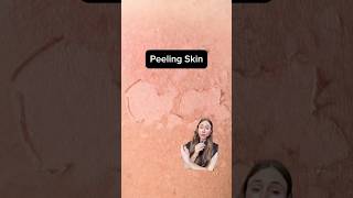 Stop Peeling Skin Fast - Dermatologist's Secret Method