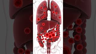 How Colon Cancer Grows 🚨 | Stage 1 to Stage 4 Explained Visually | Awareness Video #hellomisbah