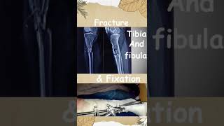 🤕🤕Tibia Fibula Fracture: Bone Fracture Treatment with External Fixation | #nursingskills