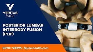 Posterior Lumbar Interbody Fusion (PLIF)