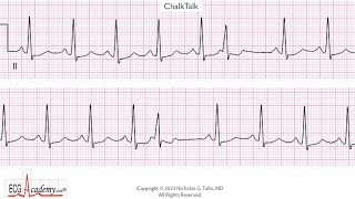 ECG Rhythm Strip Analysis – Basic ChalkTalk #565
