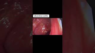 Ulcerative Colitis #GutHealth #DigestiveHealth