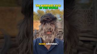 The Boy With the World’s Hairiest Face 😱 | Lalit Patidar’s Inspiring Story 🌍 #shorts