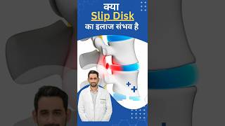 non operative slip disc treatment | बिना ऑपरेशन स्लिप डिस्क का इलाज #slipdisc #backpain  #treatment