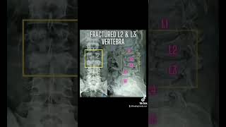 Vertebral Fracture in a 14-Year-Old After a Fall: Physiotherapy treatment #physiotherapy #pain