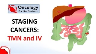 Staging cancers: TNM and I-IV systems