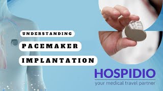 Understanding Pacemaker Implantation- A Simple Guide | HOSPIDIO