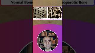 What is Osteoporosis? हड्डियां कमज़ोर करने वाली बीमारी क्या है? #spine #shorts  #pain #osteoporosis