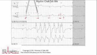 ECG Interpretation Tutorial - ChalkTalk 06 - Basic Level