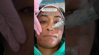 1 MONTH MICRONEEDLING + PRP update & I got a clear and brilliant laser for my hyperpigmentation✨‼️