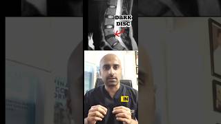 Black/dark disc. Spine surgeon explains! #pain #disc #spinecare #spinesurgeon #awareness #shorts