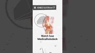 Planning Fracture Treatment in VR #medical #vr #patientcare #hospital