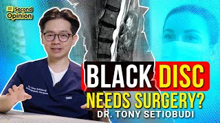 BLACK DISC: DO YOU REALLY NEED SURGERY? | DR TONY SETIOBUDI