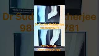 #Traumarecovery#shortstayhospital#earlymobilization#successfulsurgery#excellentoutcome