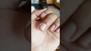 CARA AMPUH ATASI CANTENGAN DI TANGAN DAN KAKI