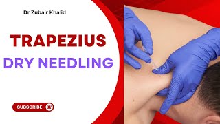 Effective Dry Needling & Electrotherapy for Upper Trapezius Trigger Points | Pain Relief Techniques