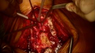 Trans-sacral fibula (Bohlman's procedure) for High Grade Spondylolisthesis