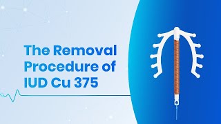 Safe and Simple SMB Copper IUD Cu 375 Removal | SMB Corporation Medical Guide