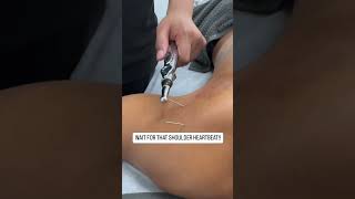 Electrifying Shoulder Pain Relief: Effective Techniques | Dry Needling