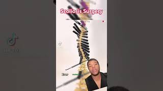 How does scoliosis surgery actually work? #Scoliosissurgery #Spinesurgery #spinesurgery