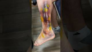 怪我から回復するには？ #怪我の回復 #リハビリテーション #AI