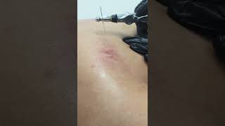 Say GOODBYE to Back Pain with Electroneedling!