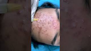 chemical peel treatment for acne | acne treatment  | Skinaa Clinic #viral #shorts