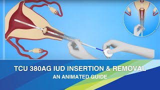 TCu 380Ag IUD Insertion & Removal: A Clear Animated Guide