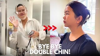 I flew to Korea to get rid of my double chin | Seoul Guide Medical