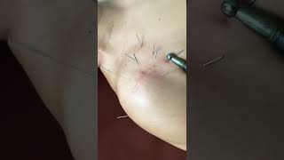 Pain RELIEF with Dry Needling and Estim