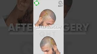 hair transplant result | best fue hair transplant | grade 3A  #besthairtransplantinindia #hairloss
