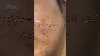 فوائد ماء القرنفل للبشرة و الحصول على البشرة الصافيه 😩✨ #skincare #grwm