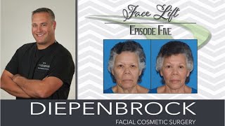 What to Know About Face Lift and Neck lifts: Before and After Photos