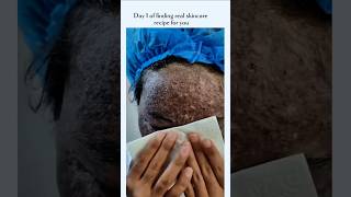 Skin Healing Journey Before and After #Short #skinconfidence #transformationstory