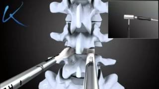 Posterior Lumbar Interbody Fusion (PLIF) Surgery