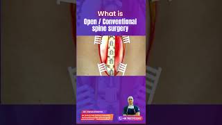 कैसे की जाती है स्पाइन की ओपन सर्जरी/ open spine surgery #spine #backpain #spinesurgeon #neckpain